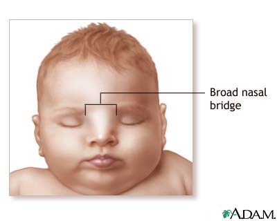 Broad nasal bridge, or widening of the base of the nose, is a relative term.