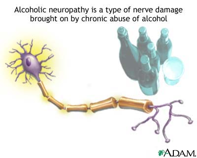 http://www.health32.com/wp-content/uploads/2010/11/alcoholic-neuropathy.jpg