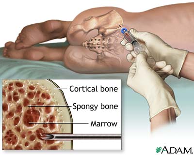 http://www.health32.com/wp-content/uploads/2010/11/bone-marrow-aspiration.jpg