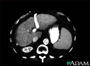 http://www.health32.com/wp-content/uploads/2010/11/liver-cirrhosis-ct-scan.jpg