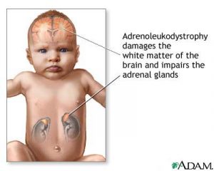 http://www.health32.com/wp-content/uploads/2010/11/neonatal-adrenoleukodystrophy-300x240.jpg