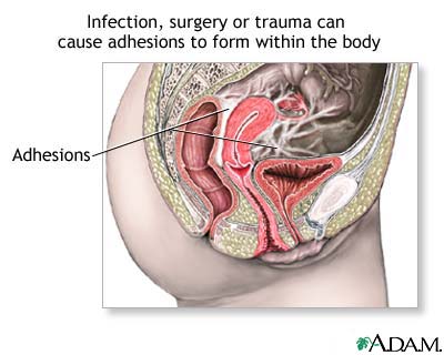 http://www.health32.com/wp-content/uploads/2010/11/pelvic-adhesions.jpg