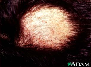 http://www.health32.com/wp-content/uploads/2010/12/alopecia-areata-with-pustules.jpg