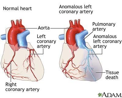 http://www.health32.com/wp-content/uploads/2010/12/anomalous-left-coronary-artery.jpg