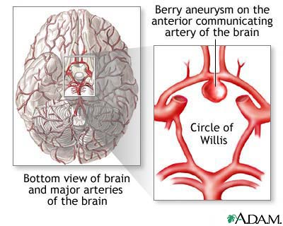 http://www.health32.com/wp-content/uploads/2010/12/cerebral-aneurysm.jpg