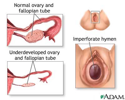 http://www.health32.com/wp-content/uploads/2010/12/primary-amenorrhea.jpg