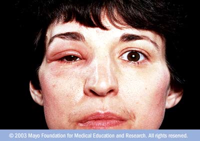 http://www.health32.com/wp-content/uploads/2010/12/r7_angioedema.jpg