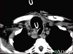 http://www.health32.com/wp-content/uploads/2010/12/thyroid-cancer-ct-scan.jpg