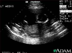 http://www.health32.com/wp-content/uploads/2010/12/ultrasound-normal-fetus-ventricles-of-brain.jpg